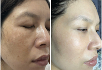 CHUYỂN GIAO CÔNG NGHỆ NÁM MỤN RỖ – HỖ TRỢ ĐẠI LÝ TOÀN DIỆN