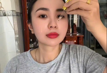 Bác Sĩ Chuyên Khoa I Nói Gì Sau Khi Điều Trị Nám Tại Bác Sĩ Hằng? | Xem Hết Clip Để Biết Sự Thật! 