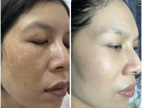 CHUYỂN GIAO CÔNG NGHỆ NÁM MỤN RỖ – HỖ TRỢ ĐẠI LÝ TOÀN DIỆN