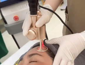 Laser CO2 Fractional – Giải Pháp Trẻ Hóa Da Toàn Diện, Tái Sinh Làn Da Từ Bên Trong