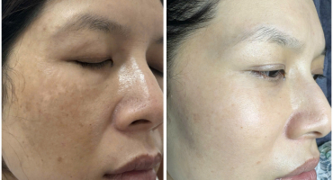 CHUYỂN GIAO CÔNG NGHỆ NÁM MỤN RỖ – HỖ TRỢ ĐẠI LÝ TOÀN DIỆN