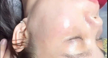 Spa Trị Nám Hiệu Quả Uy Tín Tại Tây Ninh – Giải Pháp Phục Hồi Da An Toàn