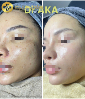 DỊCH VỤ CHUYÊN SÂU DA TÀN NHANG