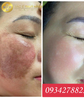 DỊCH VỤ PHỤC HỒI DA MỎNG YẾU – LỘ MAO MẠCH
