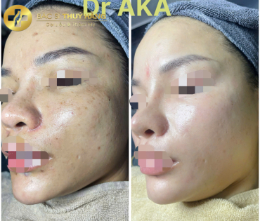 DỊCH VỤ CHUYÊN SÂU DA TÀN NHANG