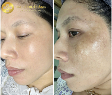 DỊCH VỤ CHĂM SÓC & CẢI THIỆN DA NÁM CHUYÊN SÂU