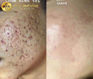 DỊCH VỤ CẢI THIỆN DA RỖ – DA KHÔNG MỊN