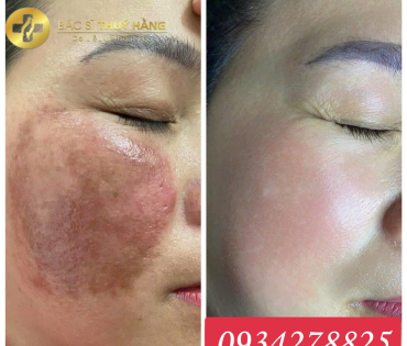 DỊCH VỤ PHỤC HỒI DA MỎNG YẾU – LỘ MAO MẠCH