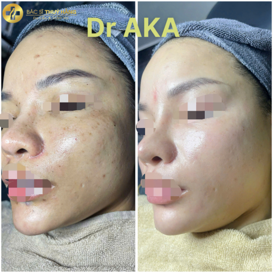 DỊCH VỤ CHUYÊN SÂU DA TÀN NHANG