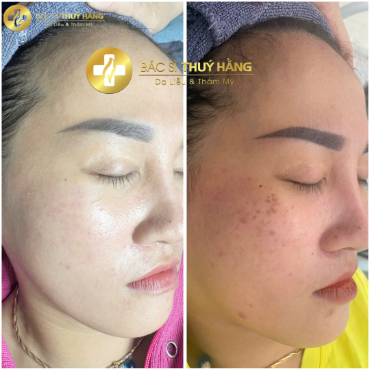 DỊCH VỤ CHUYÊN SÂU DA TÀN NHANG