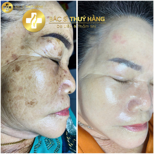 DỊCH VỤ CHĂM SÓC & CẢI THIỆN DA NÁM CHUYÊN SÂU