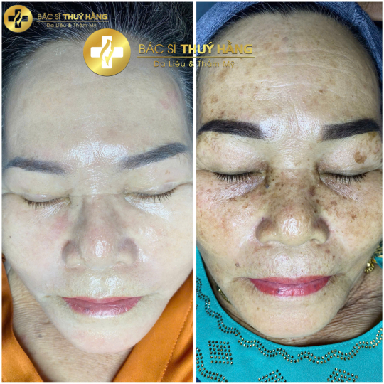 DỊCH VỤ CHĂM SÓC & CẢI THIỆN DA NÁM CHUYÊN SÂU