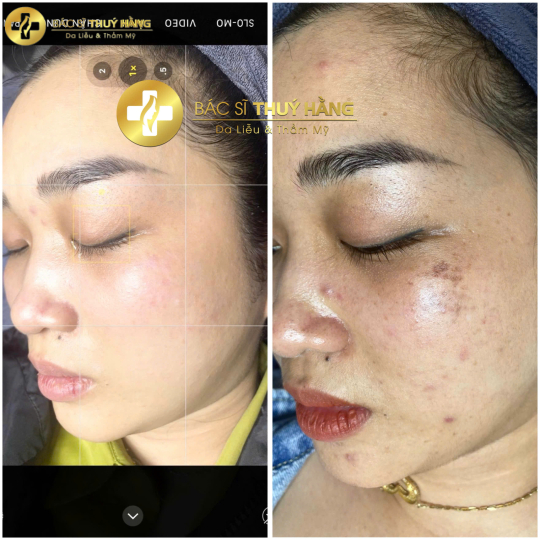 DỊCH VỤ CHĂM SÓC & CẢI THIỆN DA NÁM CHUYÊN SÂU