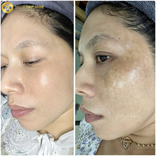 DỊCH VỤ CHĂM SÓC & CẢI THIỆN DA NÁM CHUYÊN SÂU