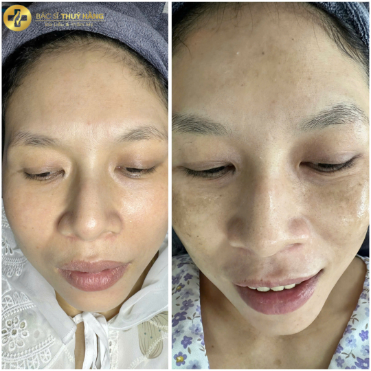 DỊCH VỤ CHĂM SÓC & CẢI THIỆN DA NÁM CHUYÊN SÂU