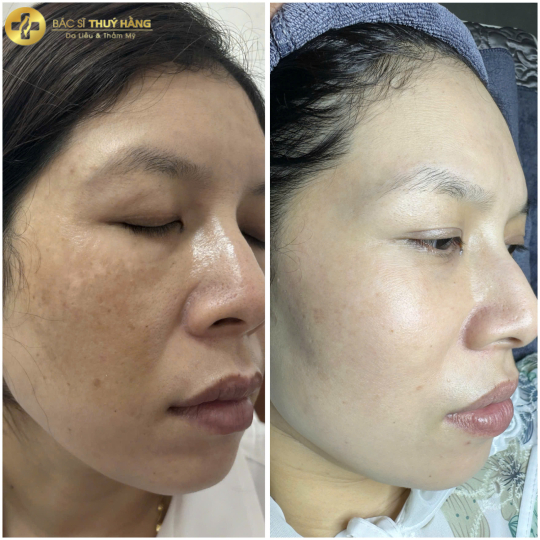 DỊCH VỤ CHĂM SÓC & CẢI THIỆN DA NÁM CHUYÊN SÂU