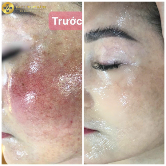 DỊCH VỤ PHỤC HỒI DA MỎNG YẾU – LỘ MAO MẠCH