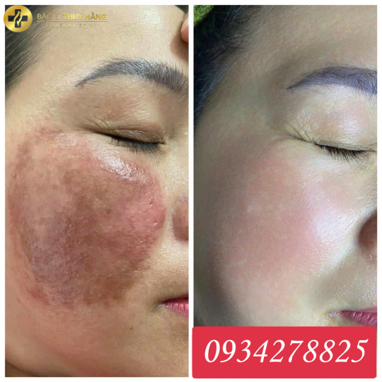 DỊCH VỤ PHỤC HỒI DA MỎNG YẾU – LỘ MAO MẠCH