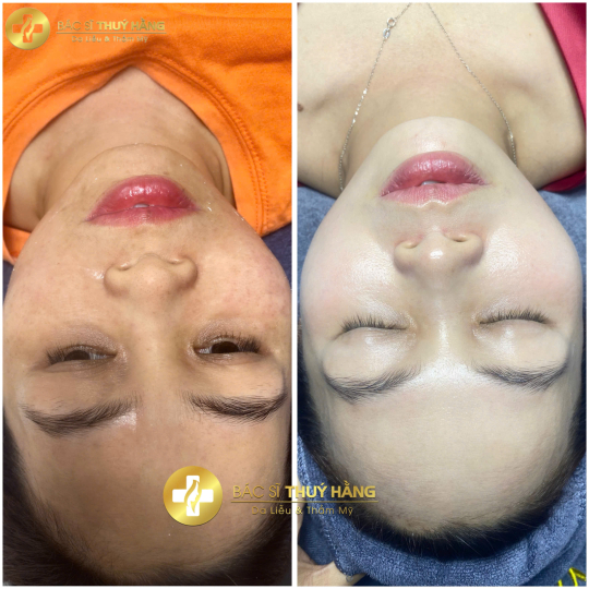 DỊCH VỤ CHĂM SÓC & CẢI THIỆN DA NÁM CHUYÊN SÂU