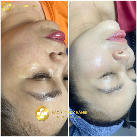 DỊCH VỤ CHĂM SÓC & CẢI THIỆN DA NÁM CHUYÊN SÂU