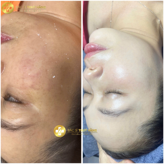 DỊCH VỤ CHĂM SÓC & CẢI THIỆN DA NÁM CHUYÊN SÂU