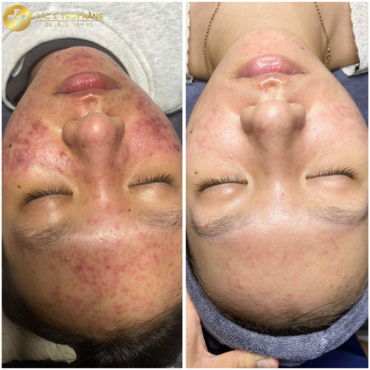 DỊCH VỤ CHĂM SÓC & ĐIỀU TRỊ DA MỤN