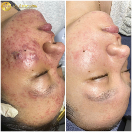 DỊCH VỤ CHĂM SÓC & ĐIỀU TRỊ DA MỤN